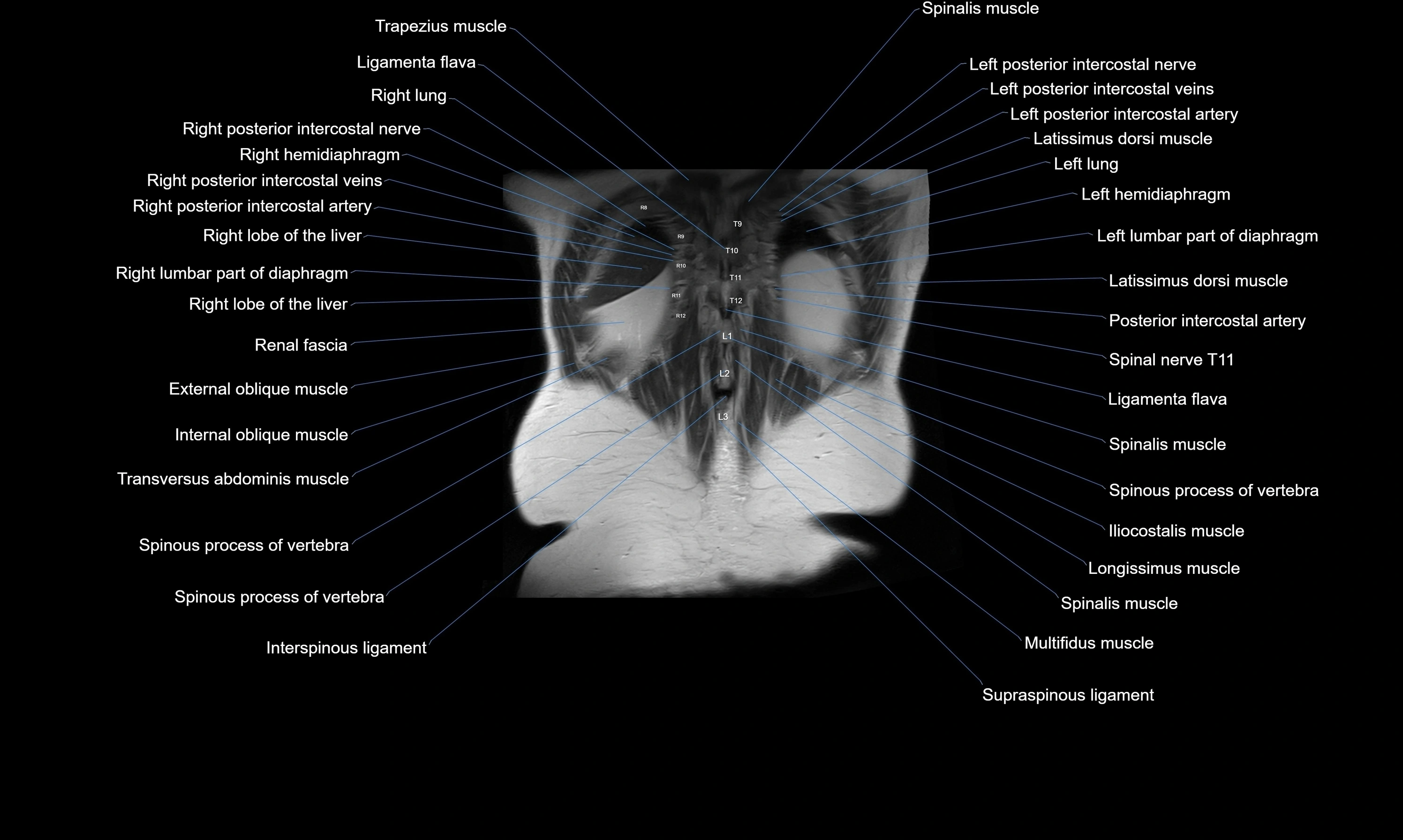 MRI Abdomen axial cross sectional anatomy radiology  image-img-00001-00052.webp